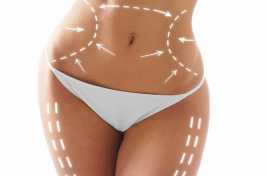 Liposculpture