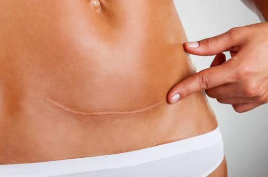 Abdominoplasty